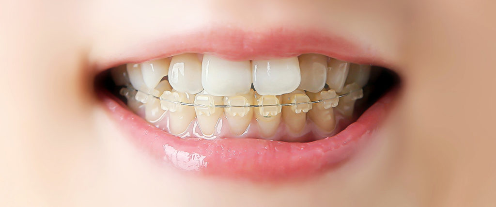 矯正治療 | 診療案内 | 熊谷デンタルクリニック|熊谷駅北口 徒歩1分の 矯正治療 | 診療案内 | 熊谷デンタルクリニック|熊谷駅北口 徒歩1分の