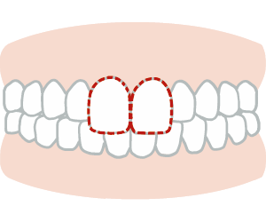 上の歯が前に出ている
(出っ歯、上顎前突)