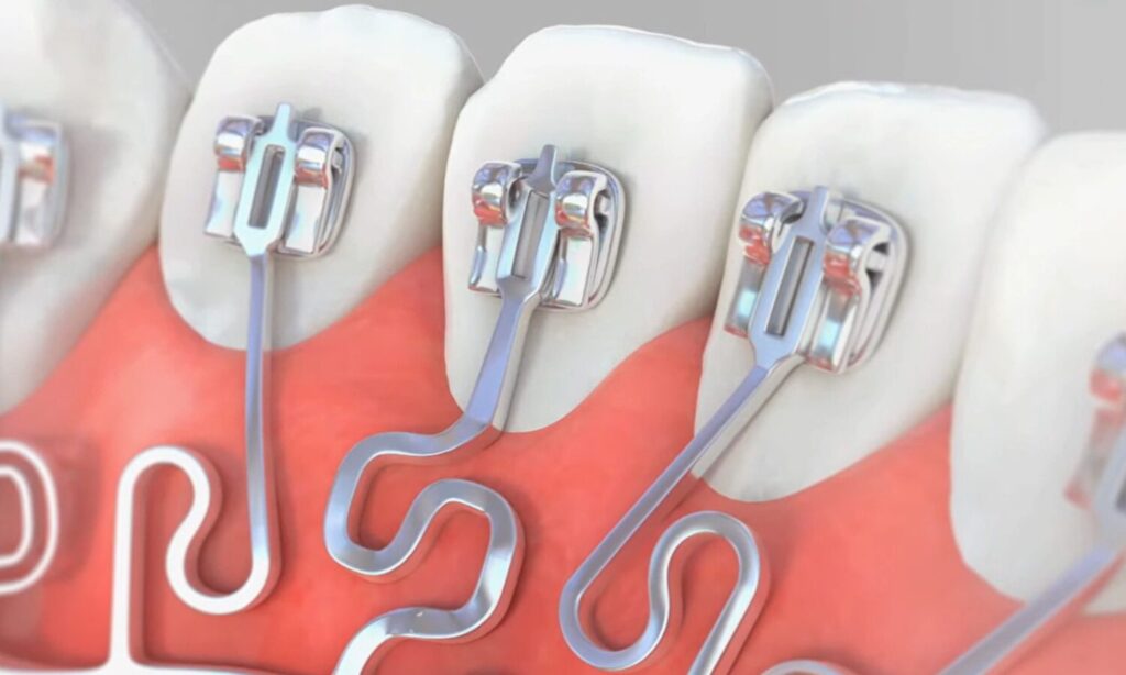 ブラーバのアーム