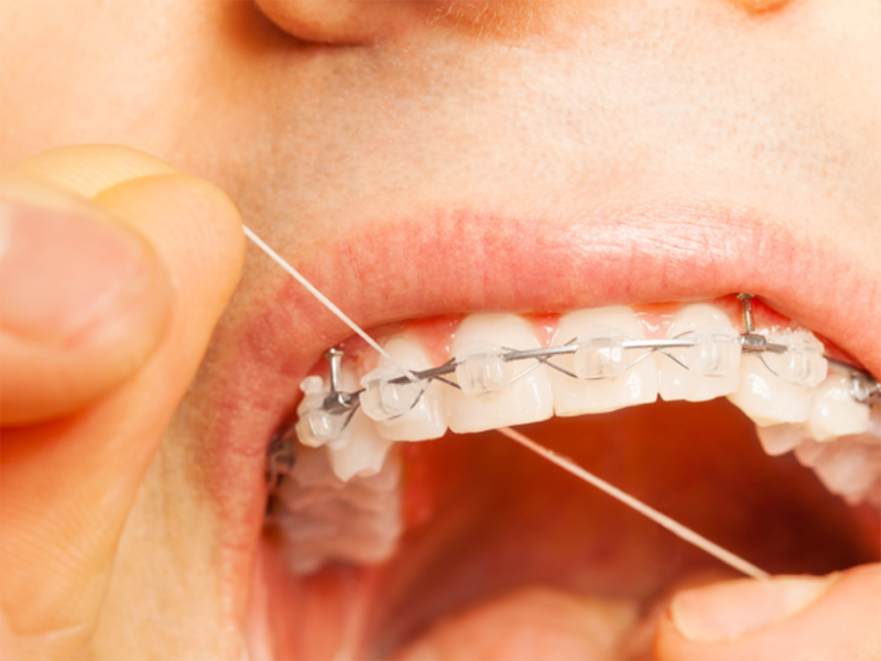 ワイヤー矯正はデンタルフロスが難しい